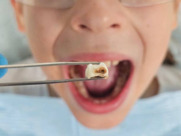 Best Emergency Dental Care for Broken or Chipped Teeth in Louisa, VA