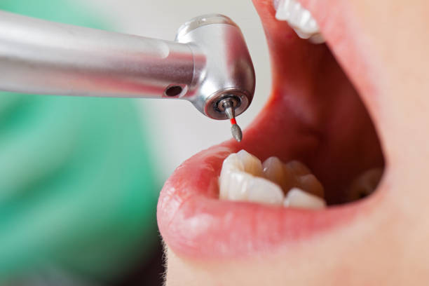 Best Emergency Dental Care for Broken or Chipped Teeth in Louisa, VA